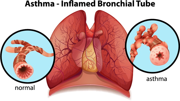 asthma diagram