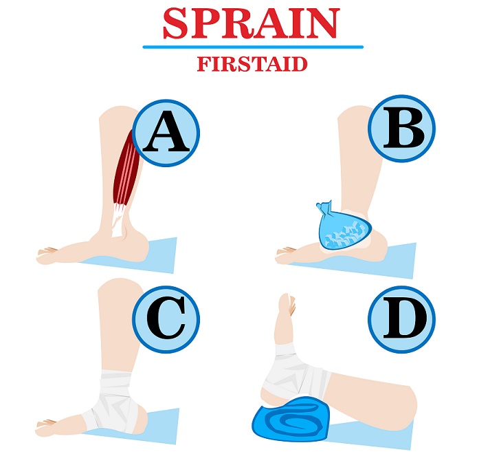 Sprain first aid vector infographic image