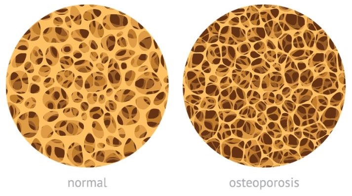 osteoporosis bone