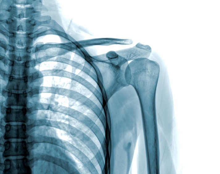 Photo of x-ray shoulder